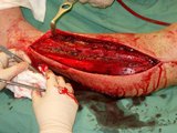 Is Fasciotomy For You?